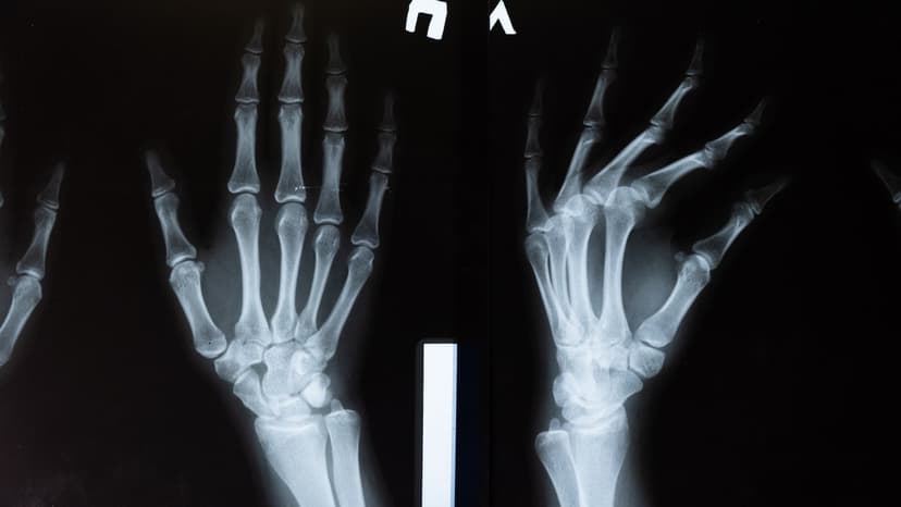 Osteoporosföreningen i Östergötland anordnar föreläsning om benskörhet 24 oktober